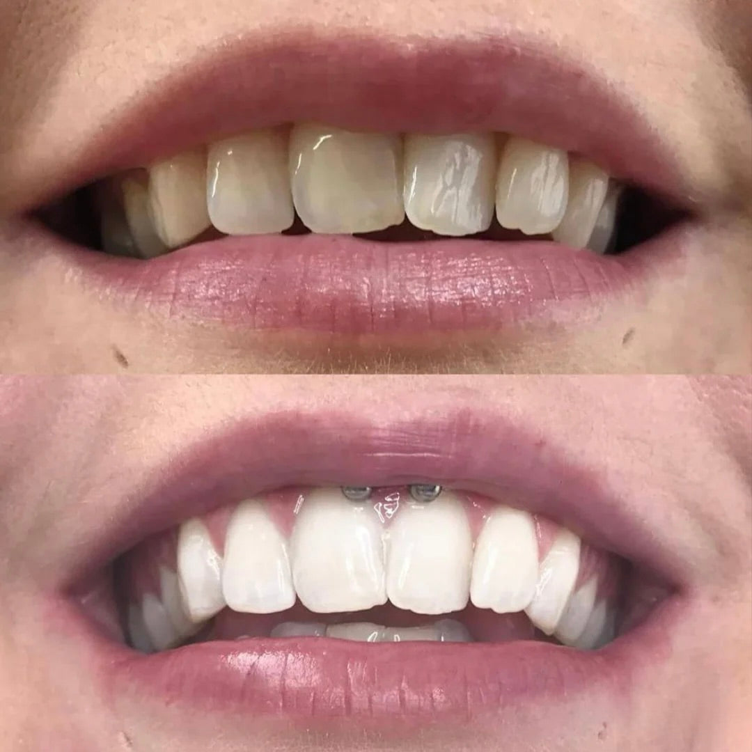 Extra-Strength Whitening 2.0